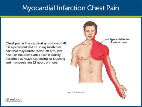 Myocardial Infarction Symptoms