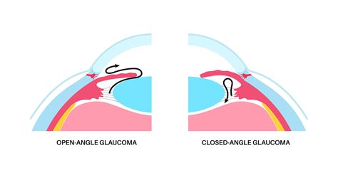 Narrow Angles And Acute Angle Closure Glaucoma Booragoon Eye Clinic