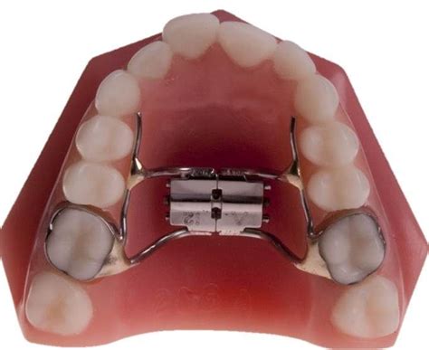 Are Expander Braces Good For Adults Palate Expander Cost Types