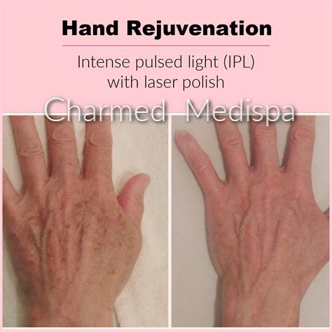 Laser Resurfacing Charmed Medispa