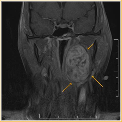 Parapharyngeal space schwanomma :MRI - Sumer's Radiology Blog