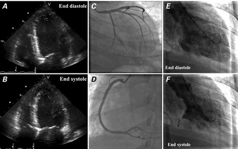 Patient 2 Echocardiography Shows Severe Hypokinesia Of The Left Download Scientific Diagram