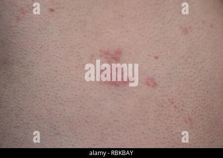 Gürtelrose Zoster oder Herpes Zoster Symptome am Arm Stockfotografie