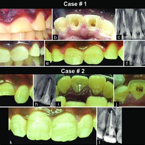 Case A E Coronoradicular Restoration For Fractured Tooth