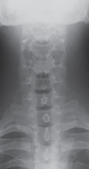 Male Cervical Spine Radiology Key