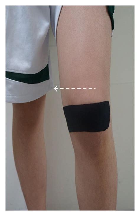 The Applications Of Kinesio Taping For Pfps Patients White Arrow Is