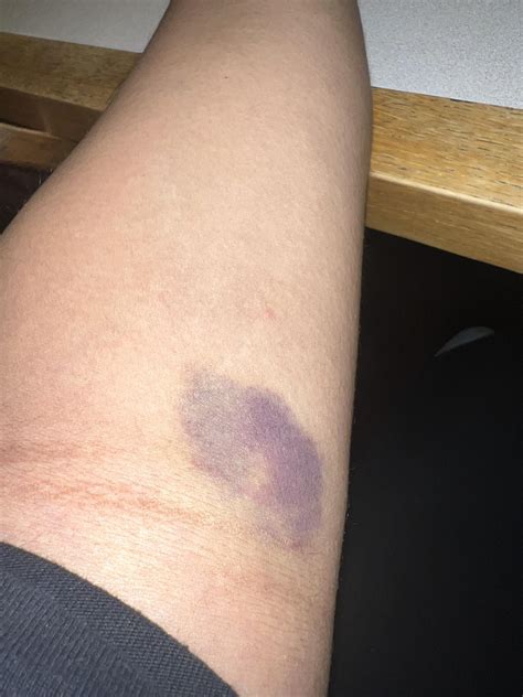 Bruise after Blood Draw - Should I be worried? : r/medical_advice