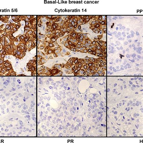 Example Of A Luminal Breast Cancer Stained With Cytokeratin