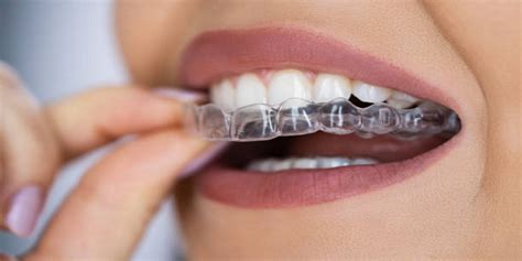 Why Invisalign Is Better Than Braces Serene Dental Spa