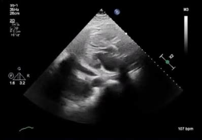 Point Of Care Ultrasound Evaluation Of Pericardial Effusion Part