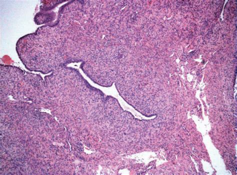 Figure 1 From Uterine Sarcoma A Rare Cause Of Uterine Inversion