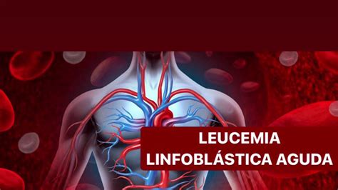 Biometria Hematica De Leucemia Linfoblastica Aguda