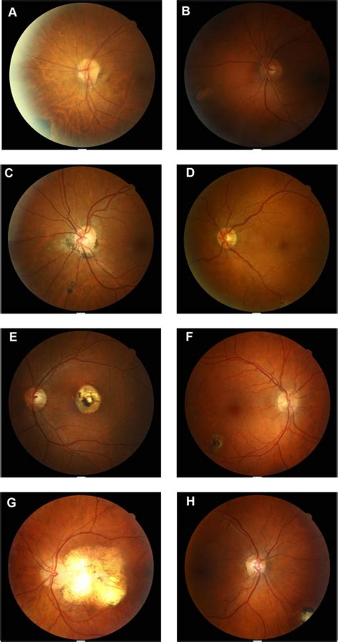 Prevalence Of Toxoplasmic Retinochoroiditis In An Australian Adult