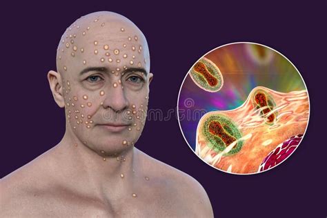 A Man With Rash From Pox Viruses 3d Illustration Stock Illustration