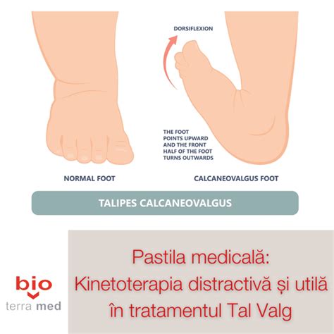 Tal Valg Remediul Este Kinetoterapia Distractiva Bio Terra Med