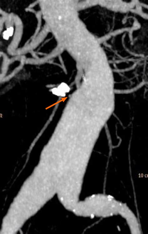 Computed Tomography Angiography Reconstruction Showing The Protrusion Download Scientific