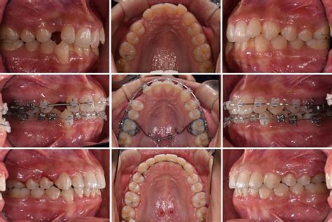 The TADs Were Inserted On The Palatal Side Of The Molars For Maxillary