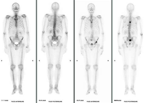 Scintigraphie Osseuse Normandim