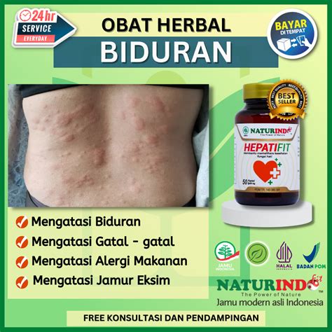 Hepatifit Obat Biduran Paling Ampuh Herbal Mengatasi Biduren Gatal