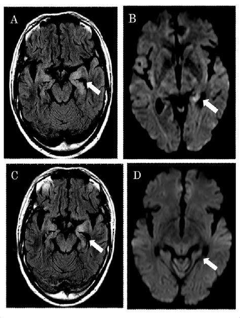 Figure 1 From Neurosyphilis Exhibiting Mri Abnormalities Mimicking