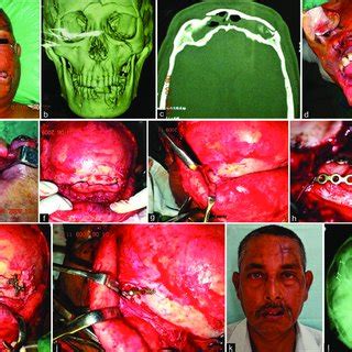 A G A Year Old Male Patient Who Sustained Panfacial Trauma In A