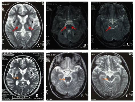 A-C was the homozygous mutation patient of Arg778Leu (c.2333G >t) in ...