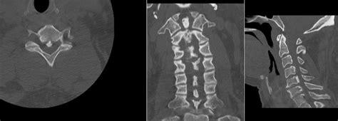 Ossification Of The Posterior Longitudinal Ligament