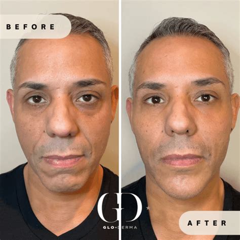 Dermal Fillers In Yardley Pa Facial Rejuvenation Treatment