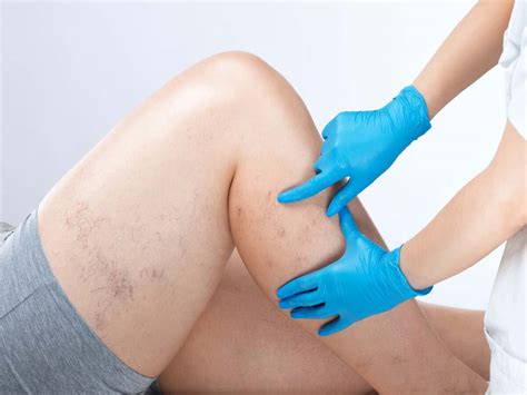 Demystifying Spider Veins Causes Prevention And Treatment Options Renewal Aesthetics