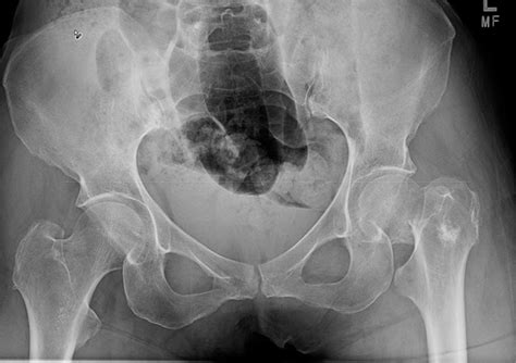 Anteroposterior AP Pelvis Radiograph Of Injury Demonstrating A