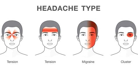 Cervicogenic Headache Patterns — Restore Physical Therapy