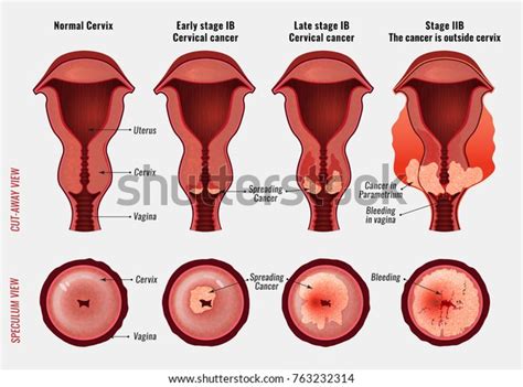 1,432 Cervix Cancer Stock Vectors, Images & Vector Art | Shutterstock