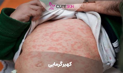 کهیر گرمایی؛ علائم و درمان آن کیوت مگ Cuteskin