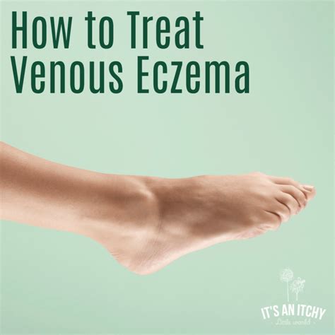 What Is Venous Eczema? | It's an Itchy Little World