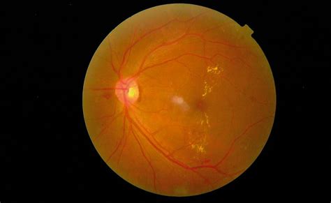 Clinically Significant Macular Edema Csme Myvisioncare Org