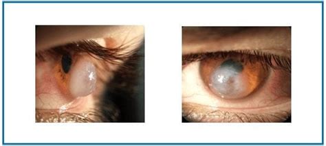 Keratoconus Eye Disorder Causes Symptoms Treatments And Risks Brian