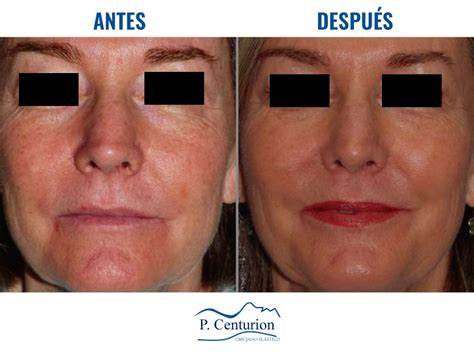 Rejuvenecimiento Facial Con C Lulas Madre En Peru Dr Centurion