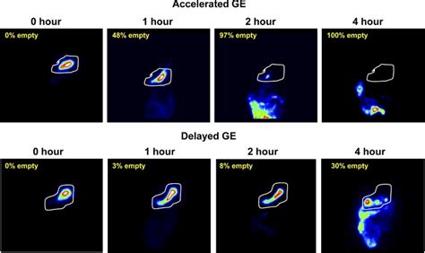 Gastric Emptying Clinical Gastroenterology And Hepatology