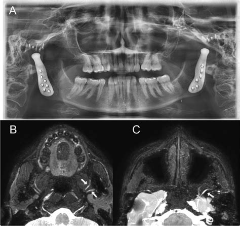 Postoperative Imaging Studies After Bilateral Custom Made Download