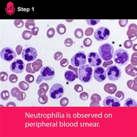 Medbullets On Twitter In Leukocyte Adhesion Deficiency Type 1 Lad 1 Neutrophilia Is