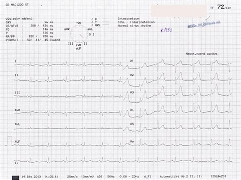 Ekg Z Praxe Medic Na Nemoci Studium Na Lf Uk