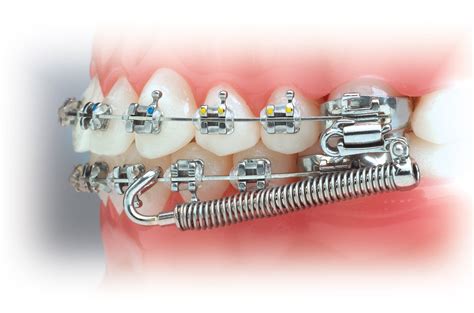 Appliances Overview Tri Valley Orthodontics