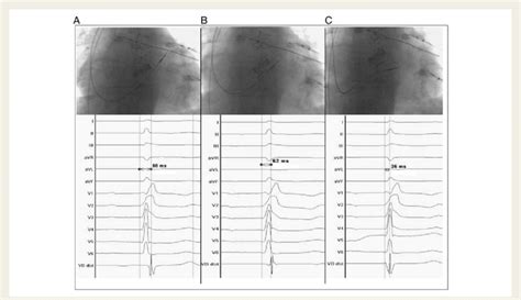 Right Ventricular Septal Lead Placement During The Combined F Ep