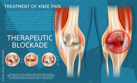 realistic illustration treatment  knee pain stock vector adobe stock