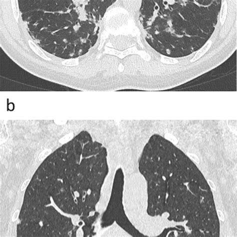 Enlarged subcarinal lymph node (white arrow) without calcifications | Download Scientific Diagram