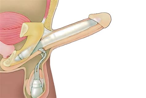 Penis Protezi Op Dr Dris K Van Cav Ldak