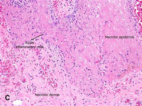 American Urological Association - Fournier's Gangrene