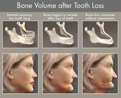 Consequences Of Missing Teeth Docdentalsmile