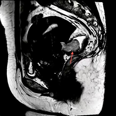 A Rare Imaging Of Rectal Polypoid Endometriosis Treated By