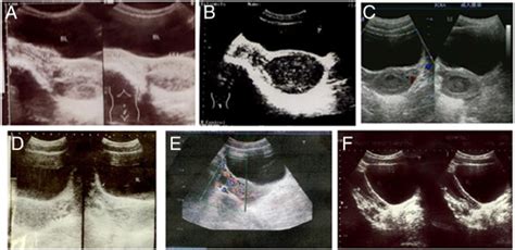 Characteristics Of Congenital Cervical Atresia In Preoperative